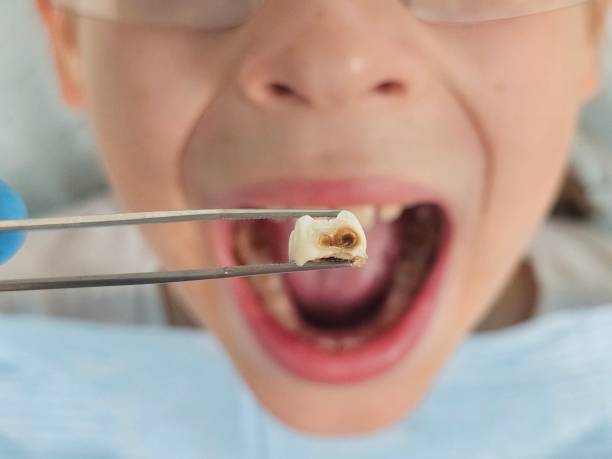 Best Emergency Dental Care for Sports Injuries in East Brooklyn, CT